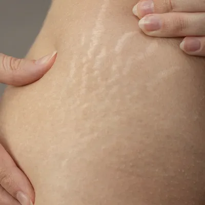 Дерматолог Филева назвала простые способы снизить риск появления растяжек  на коже | Радио 1