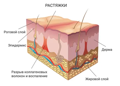 Лазерная шлифовка растяже: как убрать растяжки на животе