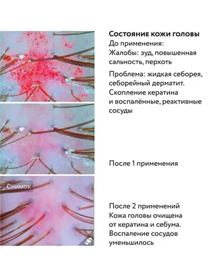 Себорейный дерматит у ребенка на голове: лечение, отзывы, фото, причины  возникновения, профилактика в домашних условиях