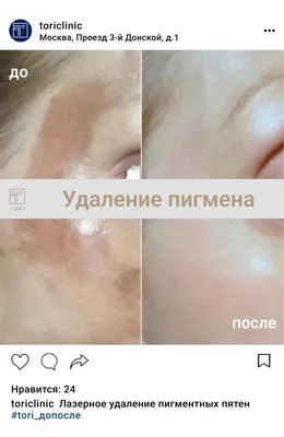 Удаление пигментных пятен в Минске МЦ Кравира