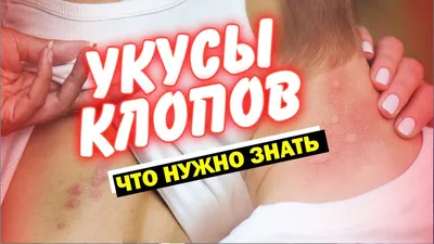 Что делать если укусил комар или другое насекомое: пчела, шмель, оса,  шершень