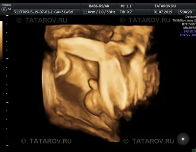 УЗИ плода при беременности – Записать на скриниг в Санкт-Петербурге