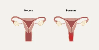 Названа причина, по которой из влагалища во время секса и спорта со звуком  выходит воздух - Газета.Ru | Новости