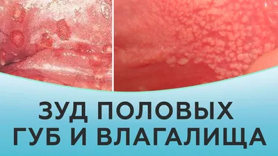 Сухость влагалища – причины, симптомы, диагностика и лечение в клинике  «Будь Здоров»