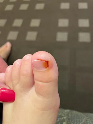 Болит угол ногтя у девочки 11 лет / Вросший ноготь у ребенка / Болит палец  у ребенка что делать / - YouTube