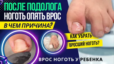 Вросший ноготь: на большом пальце ноги, что делать в домашних условиях