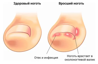 Онихокриптоз у детей и подростков | Московская Клиника Подологии