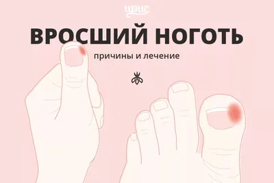 Вросший ноготь. Лечение. Харьков - Центр европейской дерматологии