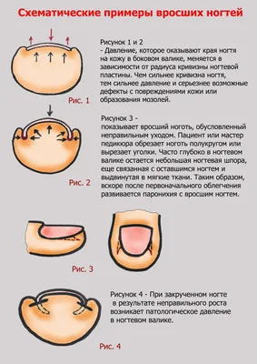 Вросший ноготь (онихокриптоз) - все о заболевании простыми словами