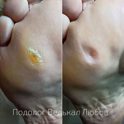 Удаление вросшего ногтя у ребенка в Киеве