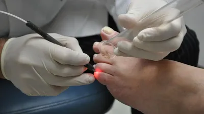 Лечение вросшего ногтя скобами Киев | МЦ SENSAVI