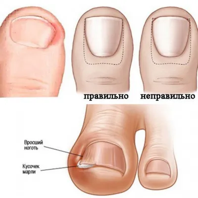 Лечение вросшего ногтя в Санкт-Петербурге | Хирург Юрий Бажов