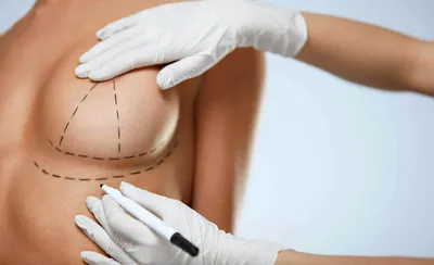Реабилитация после маммопластики: правила ухода после пластики груди | блог  Gold Laser