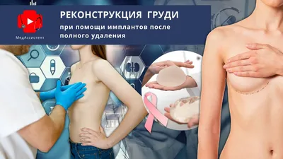 Реконструкция груди после рака при помощи имплантов - YouTube