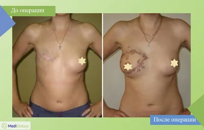 Замена грудных имплантов в Киеве ≡ MED CITY | Замена имплантов молочных  желез
