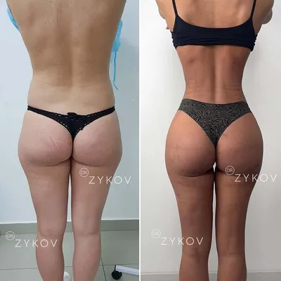 Фото до и после аппаратной косметологии | Damas Medical Center