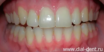 Отбеливание зубов после ортодонтического лечения