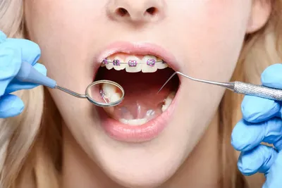 Как долго болят зубы после установки брекетов? - энциклопедия Ochkov.net