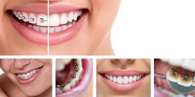 Лечение брекетами не только делает зубы ровными, но и меняет лицо и улыбку  человека