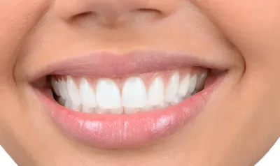 Зубы после брекетов, что происходит после снятия брекет системы? | Soprano
