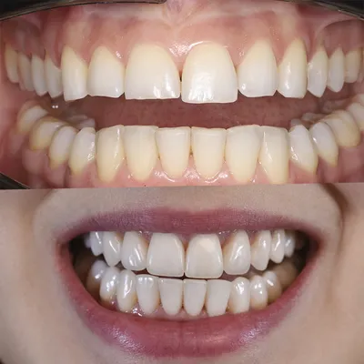 Патологическая стираемость зубов: лечение, диагностика | клиника Seline  Москва