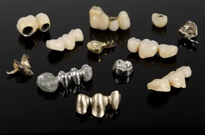 Вставные зубы – протезирование, имплантация