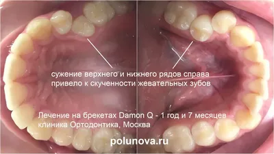 Жевательные зубы: функция, уход и важность посещения дантиста | Информация  о молярах