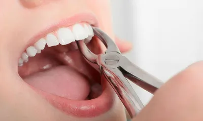Удаление зубов - Стоматологическая клиника Клевер