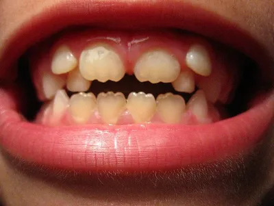 Виды и причины аномалий форм зубов