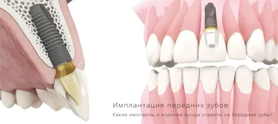 Протезирование группы жевательных зубов в ТОП 1 клинике Москвы - Немецкий  Имплантологический Центр
