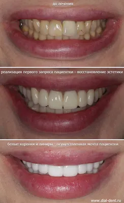 Стираемость зубов [повышенная, врождённая или приобретённая]