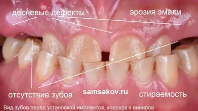 Когда необходимо удалять коренные зубы, показания и противопоказания,  особенности процедуры и ухода после нее