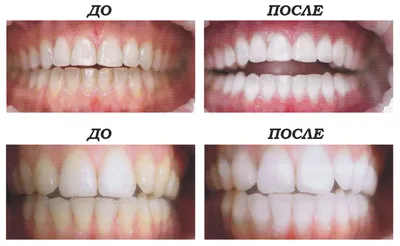 Белоснежные зубы – реализация мечты при помощи белых керамических коронок и  виниров