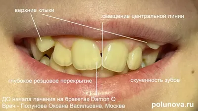 Как быстро остановить стираемость зубов – Альянс бьюти-ортопедов, Москва