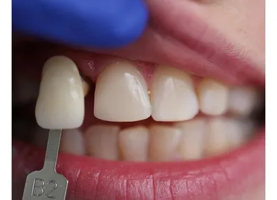Аномалии развития детских зубов - симптомы и лечение – статьи детской  стоматологической клиники «Мартинка»