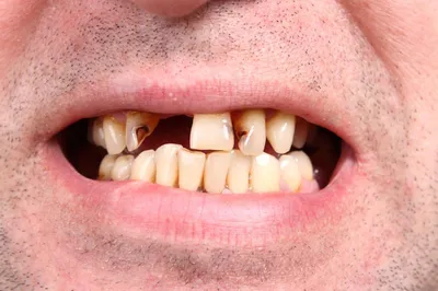 Реставрация и восстановление зубов | \"МаксиДент\" стоматологическая клиника