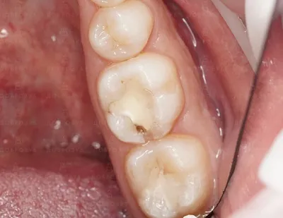 Скученность зубов фото: нижней челюсти