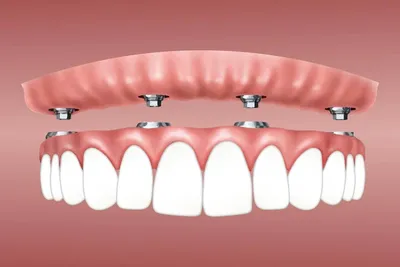 Чем вкладки отличаются от пломбирования зубов? — Статьи стоматологии  Династия-С