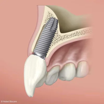 10 фактов о потере зубов, которые нужно знать | Стоматология Доктор Мартин  | Дзен