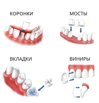 Наращивание зубов в Новосибирске - Доступная Стоматология