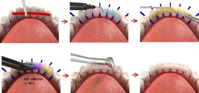 Имплантация передних зубов в клинике БИЭМ СПб: стоимость и особенности