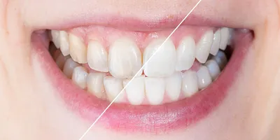 Прозрачные зубы - причины, что делать, как исправить