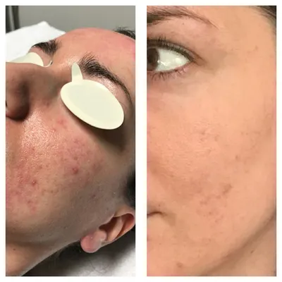 Фото до и после Процедура фототерапии акне — Сеть косметологических клиник  Эпилайк