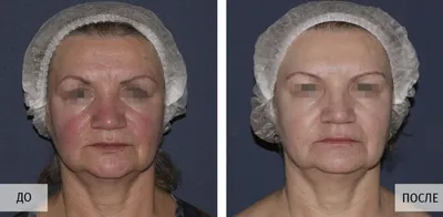 Фотографии до и после М22 и фотофракшн, AcuPulse, проводим в клинике  Premium Aesthetics