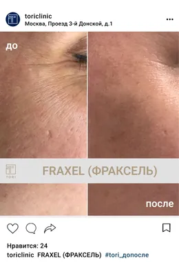 Fraxel (Фраксель) - цены, этапы проведения, показания и противопоказания,  отзывы