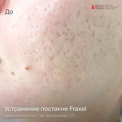 Удаление морщин с помощью лазера - Premium Aesthetics