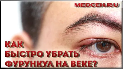 Как быстро убрать фурункул на веке? - YouTube