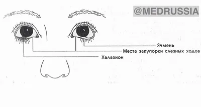 Как быстро убрать мешки под глазами. Советы косметолога | Статья