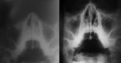 Лечение гайморита у стоматолога • Стоматология Venezia