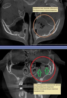 Рентгенография придаточных пазух носа - «Гайморит хронический. Как помогает  рентген поставить правильный диагноз. Симптомы гайморита без рентгена, как  понять, что нужно бежать к лору. » | отзывы